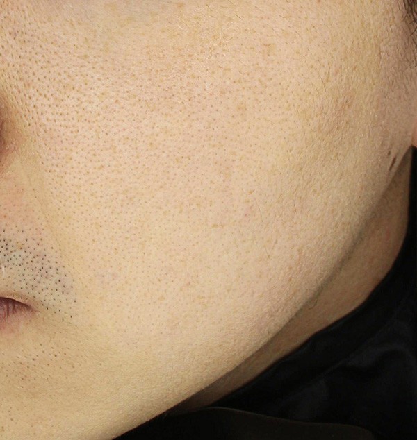 홍조와 민감성 피부