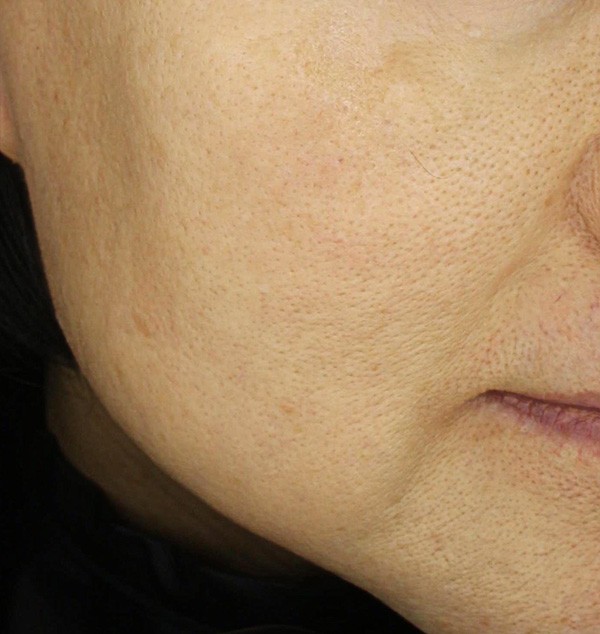 홍조와 민감성 피부