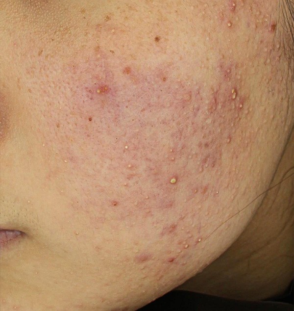 여드름과 흉터