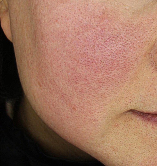 홍조와 민감성 피부