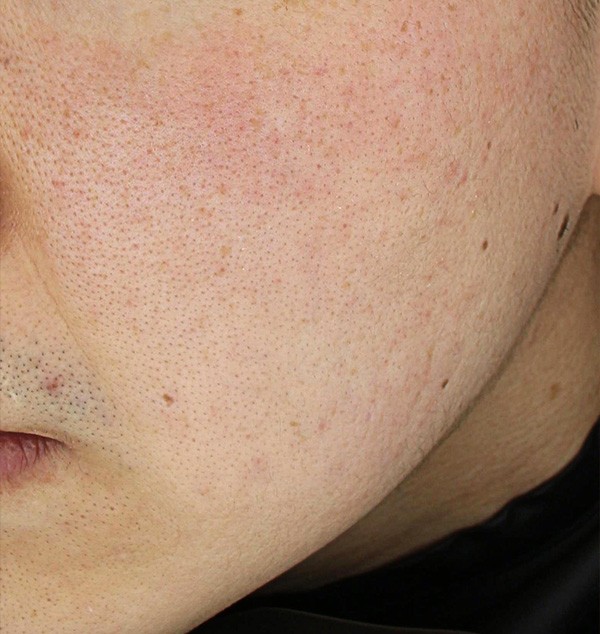 홍조와 민감성 피부